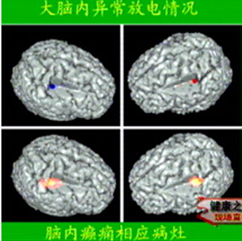 癫痫